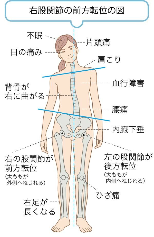 ひも療法 足の長さを揃えると背が伸びる 股関節を正しい位置に戻す姿勢矯正方法 ゆほびかweb